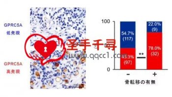 世界范围内前列腺癌的发病率较高，早期诊断早