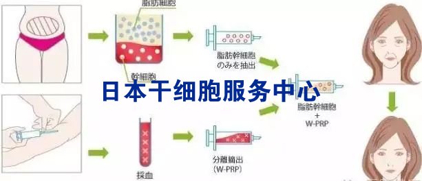 将提取的脂肪进行分离,纯化,培养,扩增,制成纤维前体细胞注射液,然后